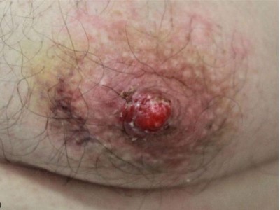 Erythematöse Läsion der linken Brustwarze