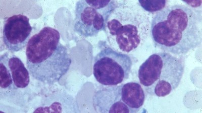 Myelomzellen im Knochenmark