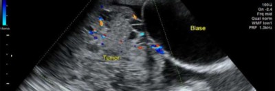 Sonographische Darstellung der Raumforderung