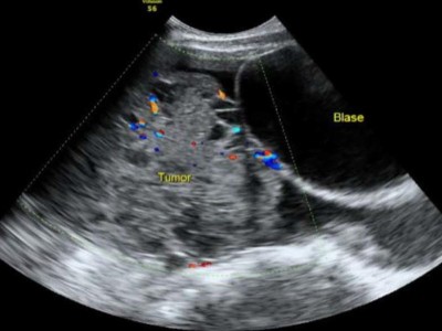 Sonographische Darstellung der Raumforderung