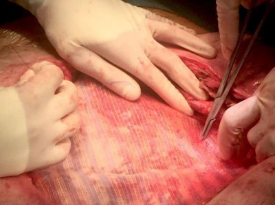 The Anal Fistula Plug versus the mucosal advancement flap for the treatment  of Anorectal Fistula (PLUG trial) | springermedizin.de