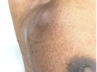 Rechte Brust mit Tumor und beginnender Hautulzeration