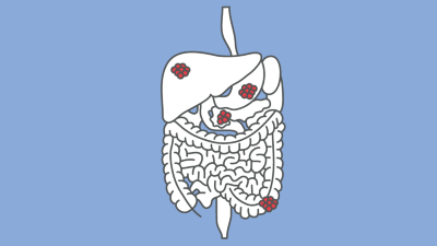 Gastrointestinale Tumoren