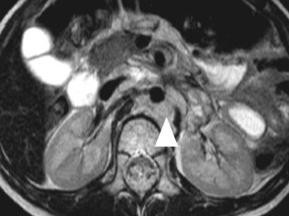Typische Ausbreitungswege des Neuroblastoms