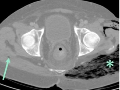 Weichteilemphysem der linken Glutealmuskulatur und des angrenzenden subkutanen Fettgewebes