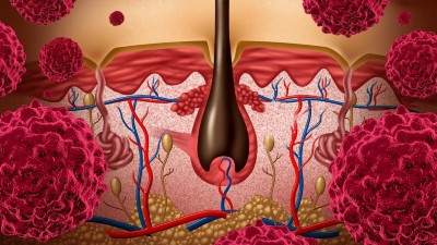 Acne inversa: Frühe Diagnose und Therapie kann Lebensqualität deutlich verbessern