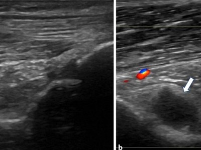 Ultraschalllängsschnitt der Fossa olecrani