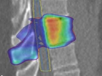 Stereotaktische Strahlentherapie (SBRT) einer solitären ossären Metastase in dem Brustwirbelkörper