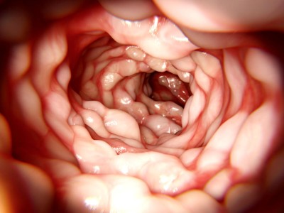Endoskopiebefund bei Morbus Crohn