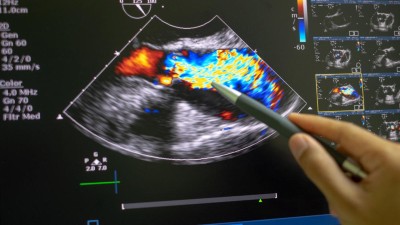 Echokardiografie bei Aortenstenose