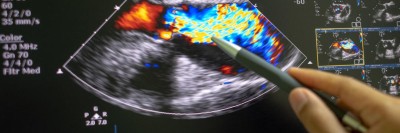 Echokardiografie bei Aortenstenose