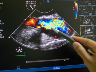 Echokardiografie bei Aortenstenose