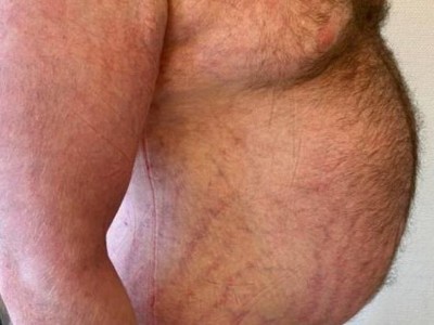 Striae distensae am Rumpf und an den Oberarmen bei Stammfettsucht