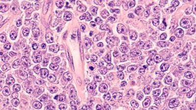 Diffus großzelliges B-Zell-Lymphom (DLBCL)
