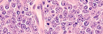 Diffus großzelliges B-Zell-Lymphom (DLBCL)