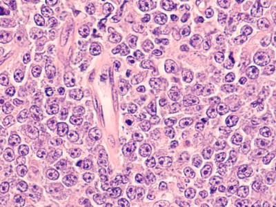 Diffus großzelliges B-Zell-Lymphom (DLBCL)