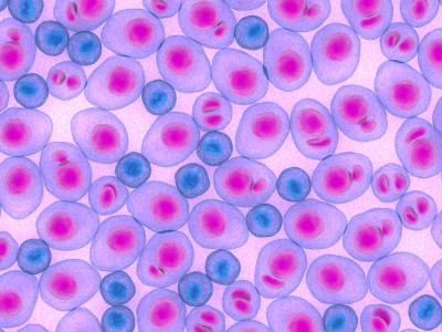 Multiples Myelom