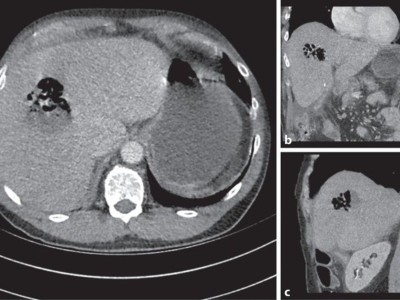 Computertomographie mit 6 cm messendem Leberabszess