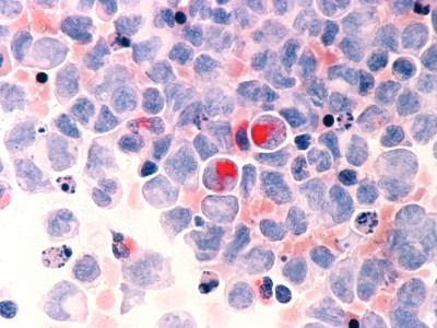 Histopathologischer Befund bei akuter myeloischer Leukämie