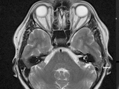 Schichten aus der durchgeführten MRT