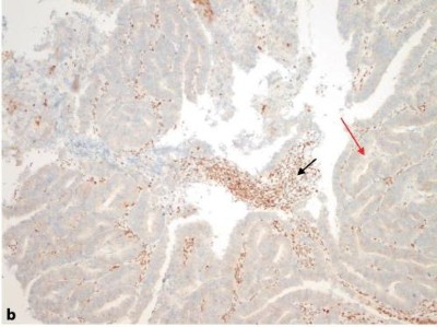 Mismatch-Reparatur-Defizienz (dMMR) beim Endometriumkarzinom