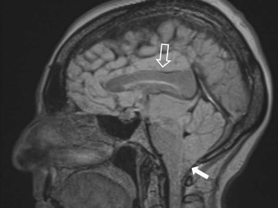 Kraniale MRT, sagittale FLAIR-Wichtung: frontotemporales „brain sagging“