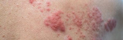 Herpes Zoster am Rücken