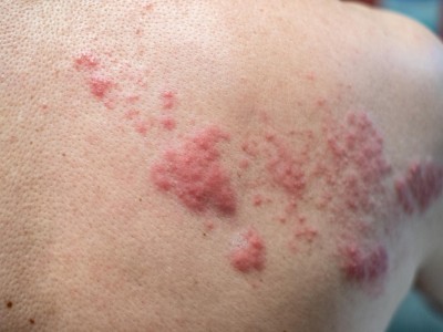 Herpes Zoster am Rücken