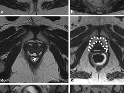 MRT-Aufnahme bei Bandverletzung bzw. Beckenbodenschwäche