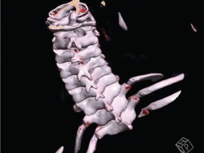 Rekonstruktion der Halswirbelsäule im CT