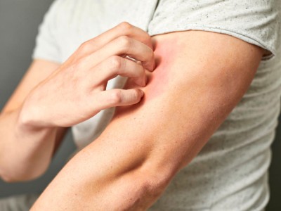 Eine Person, die sich juckt und kratzt