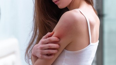 Atopische Dermatitis