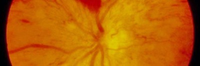 Proliferative diabetische Retinopathie