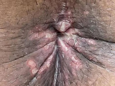 Perianale Affenpocken-Infektion