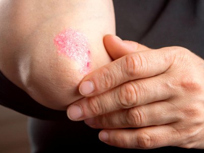 Psoriasis am Ellenbogen