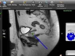 MRT(Magnetresonanztomographie)-(in-bore)-Biopsie der Prostata