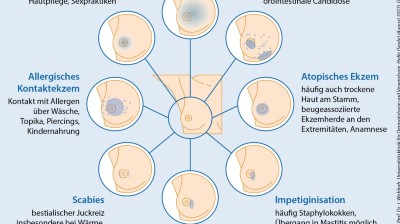 One Minute Wonder: Erkrankungen der Mamillenhaut