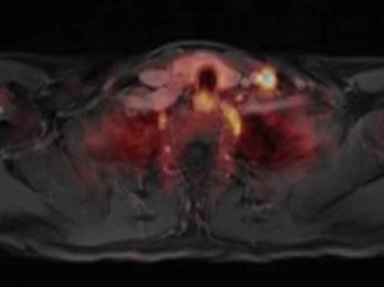 PSMA-spezifische Traceranreicherung zweier Lymphknoten tief linkszervikal