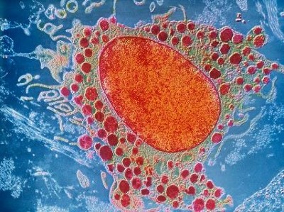 Mastozytose - Neue Therapieoption mit KIT D816V-Inhibitor