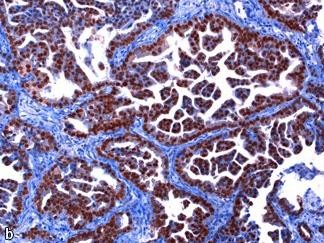 NSCLC Adenokarzinom mit EGFR-Mutation und TTF-1-Positivität