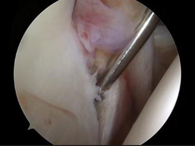 Transmurale Ruptur der Supraspinatussehne
