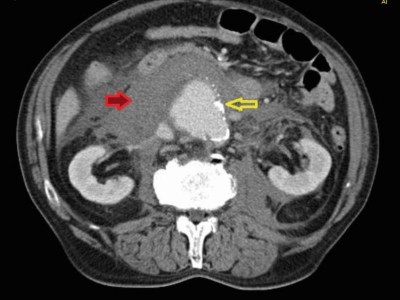 Perforiertes Aortenaneurysma im CT
