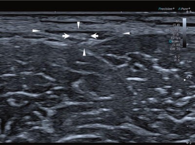 Nervus cutaneus femoris lateralis im Ultraschall