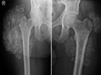 Tumorkalzinose in der Hüfte