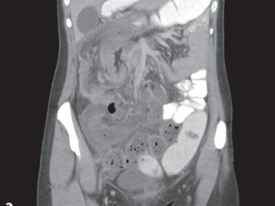 CT bei Invagination des terminalen Ileums in das Colon ascendens