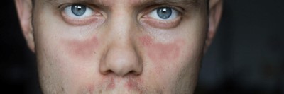 Systemischer Lupus erythematodes Gesicht Mann