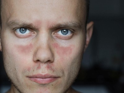 Systemischer Lupus erythematodes Gesicht Mann