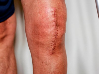 Narbe nach Kniegelenkersatz-Operation