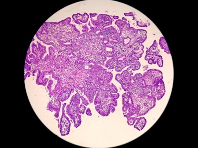 Adenokarzinom der Prostata
