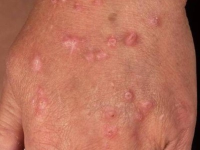 Multiple Papeln auf der Hand bei chronischer Prurigo